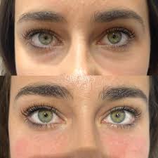 Tratamiento Antiojeras: Sérum Contorno de Ojos para Una Mirada Fresca y Radiante